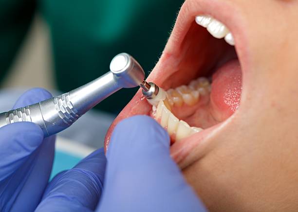 Best Wisdom Tooth Removal  in USA